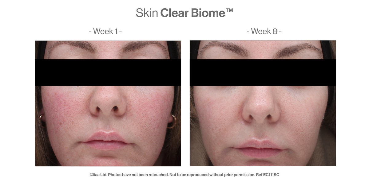 Skin Clear Biome™