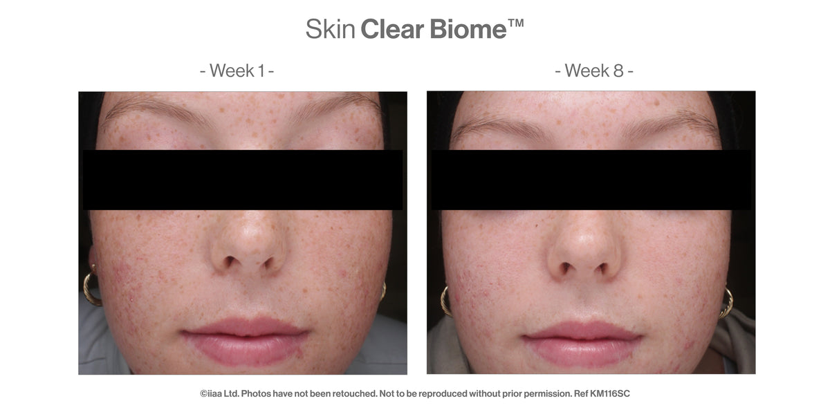 Skin Clear Biome™